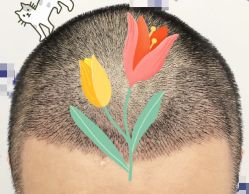 -大麦微针植发全国连锁