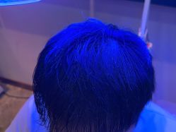 -碧莲盛·不剃发植发