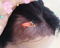 -大麦微针植发全国连锁