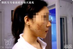 -韩医生专业祛痘连锁机构
