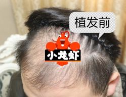 -大麦微针植发全国连锁