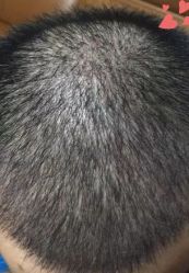 -大麦微针植发丨全国连锁