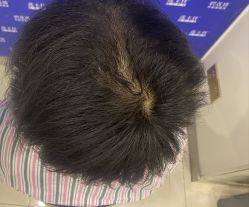 -碧莲盛·不剃发植发