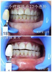 牙齿美白-光SPA科技美肤