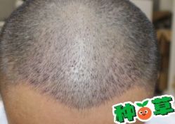 -大麦微针植发丨全国连锁