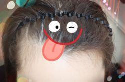 -大麦微针植发全国连锁