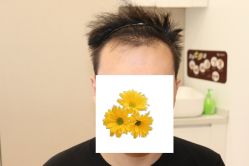 -大麦微针植发丨全国连锁