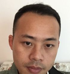 -碧莲盛·不剃发植发