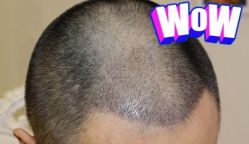 -大麦微针植发丨全国连锁