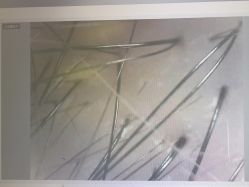 -碧莲盛·不剃发植发