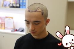 -大麦微针植发丨全国连锁