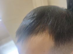 -碧莲盛·不剃发植发