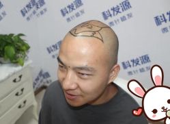 点击看大图 -大麦微针植发丨全国连锁