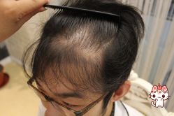 -大麦微针植发丨全国连锁