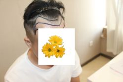 -大麦微针植发丨全国连锁