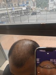 -碧莲盛·不剃发植发