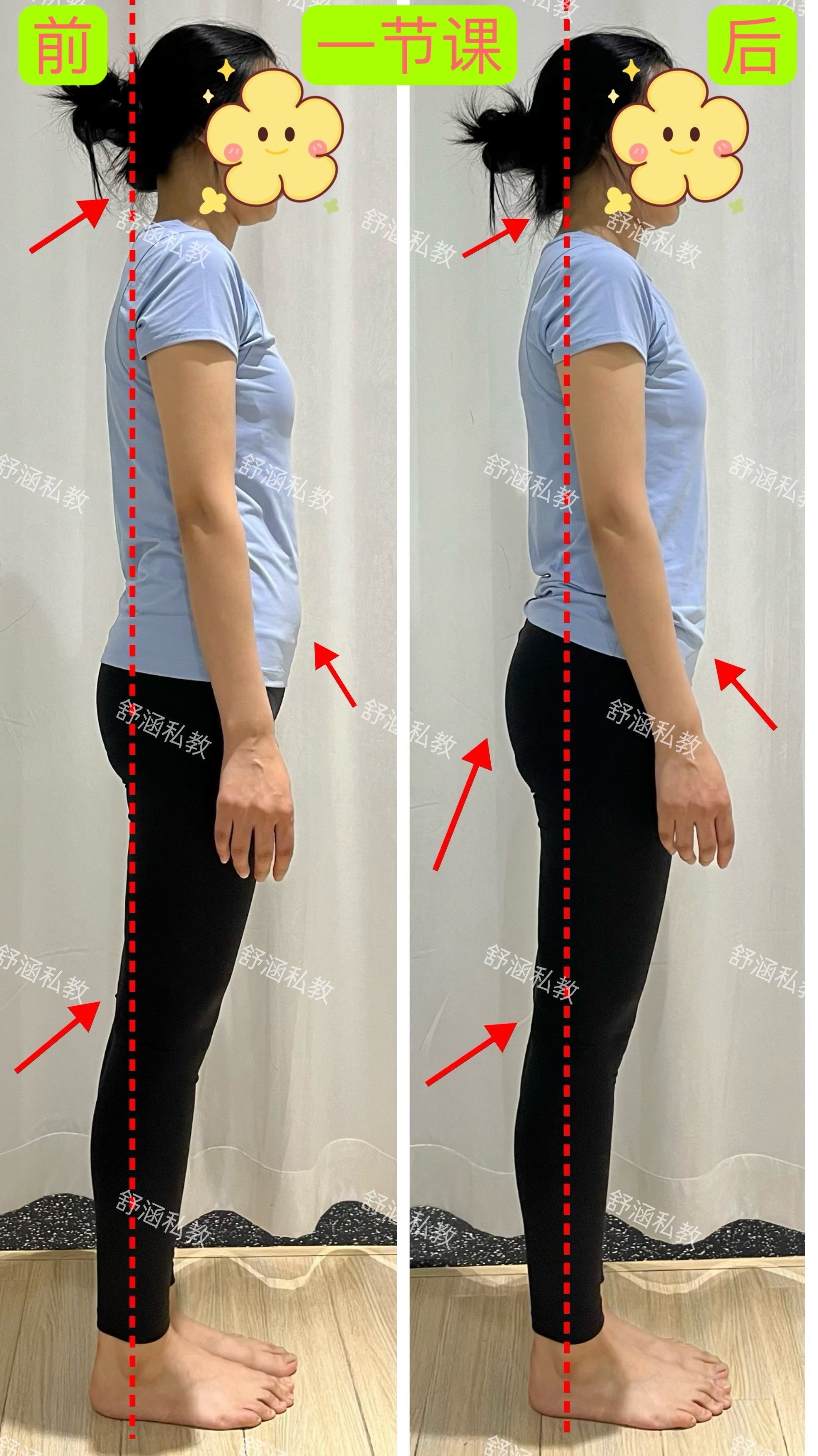 膝超伸对体态的影响