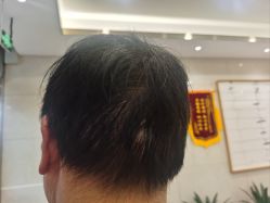 -碧莲盛·不剃发植发