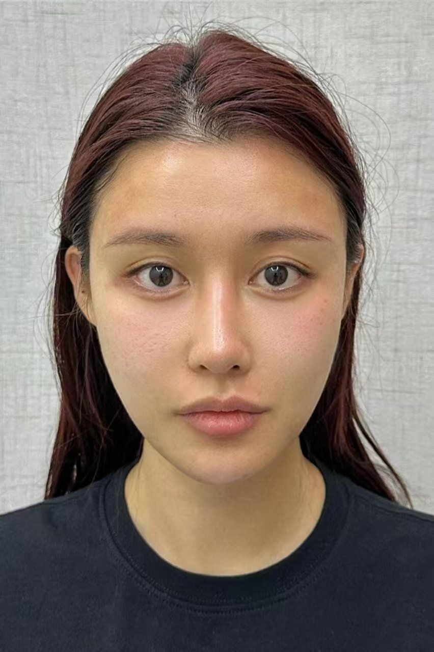 前段时间一直被脸部凹陷困扰