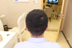 点击看大图 -大麦微针植发丨全国连锁
