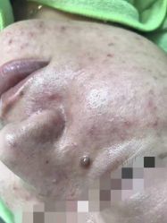 -苗医生草本科技祛痘