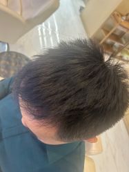 -大麦微针植发丨全国连锁