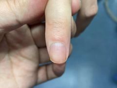 -Andrew指甲专科灰指甲·甲沟炎矫正·3D步态矫形鞋垫定制(上海法华镇路旗舰店)