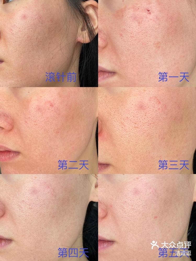 滚针美容效果怎么样